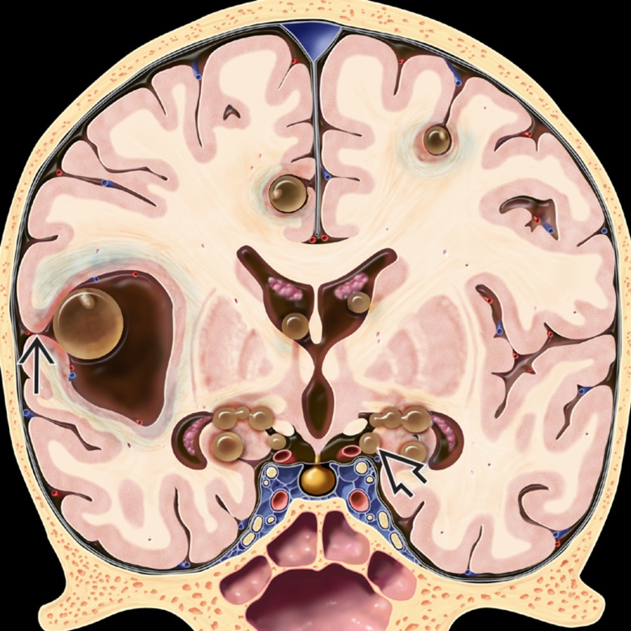 Coronal graphic shows subarachnoid & ventricular neurocysticercosis (NCC). Convexity cysts have a scolex and surrounding inflammation. Note that inflammation around the largest cyst "seals" the sulcus
, making it appear parenchymal. Racemose cysts
are multilocular, nonviable in the basal cisterns & typically lack scolex.