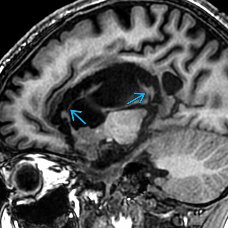 Paramidline sagittal T1 MR in a 7 year old with intractable epilepsy shows near-complete absence of the corpus callosum
due to surgical discontinuity.