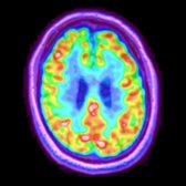 Axial fused FDG PET/MR in a 61-year-old man with apathy, disinhibition, and lack of empathy shows subtle decreased metabolism in the medial frontal lobes
. Not pictured is decreased activity in the right temporal lobe.