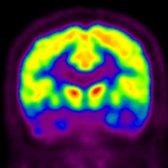 Coronal FDG PET in a patient with FTD exhibits glucose hypometabolism in frontal
and temporal lobes
.