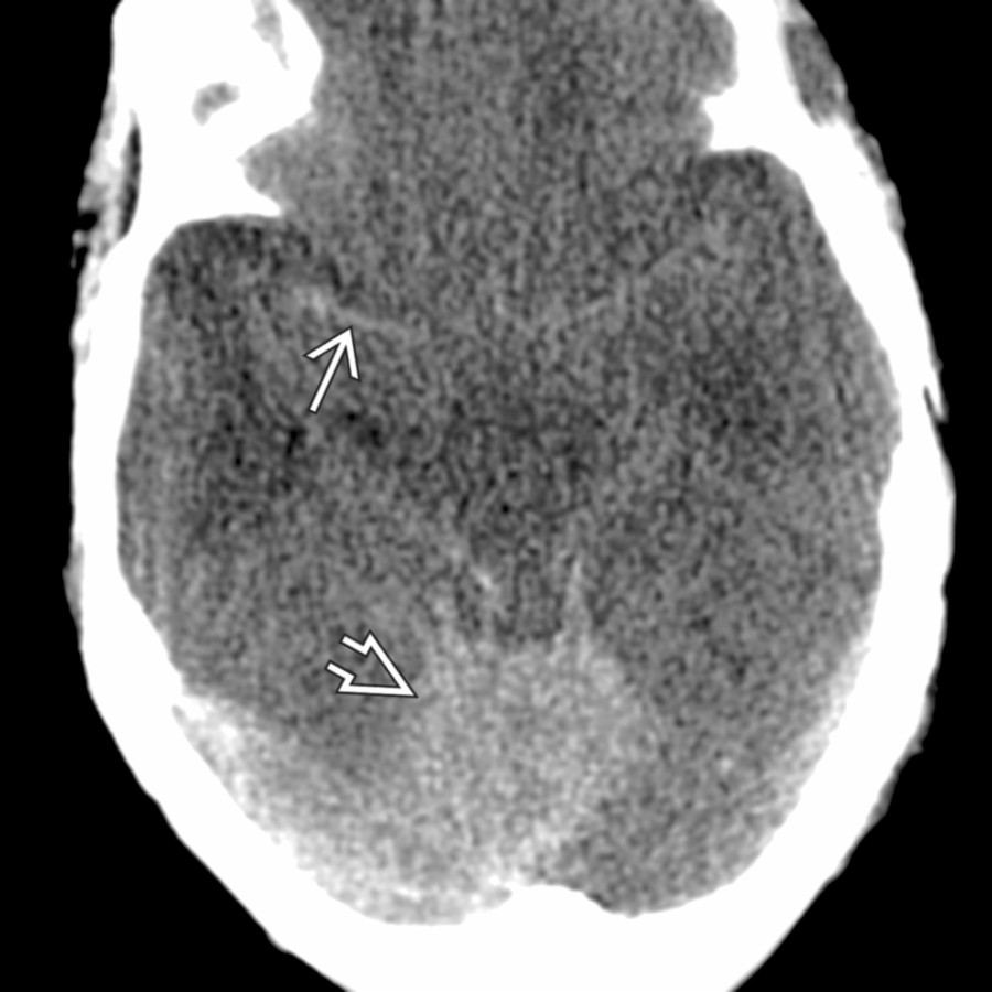 Axial NECT shows false dense MCA sign in a patient with diffuse cerebral edema. Low-density brain makes normal MCA
and cerebellum
appear hyperdense.