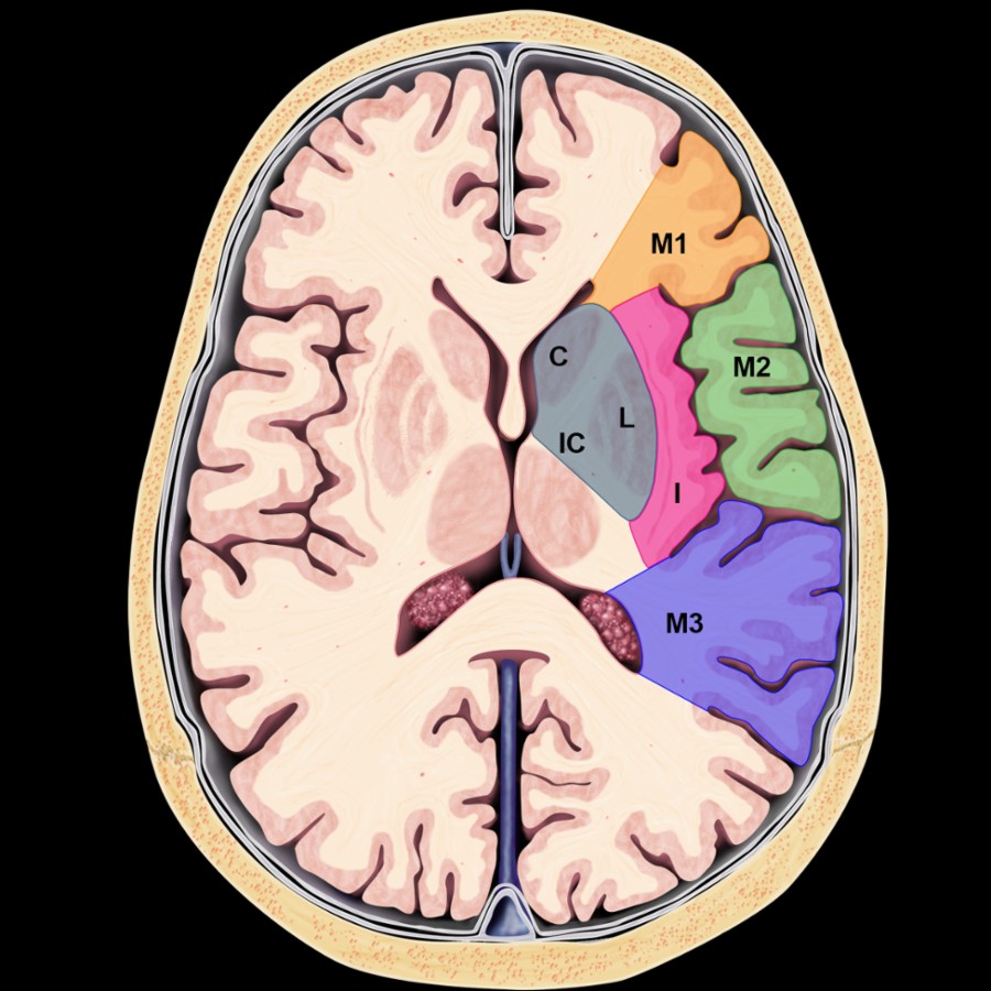 Graphic shows anatomic regions for calculating the ASPECTS score. M1-M2 represent the MCA cortex with each area allotted 1 point. The insular cortex (I), lentiform nuclei (L), caudate head (C), and internal capsule (IC) are scored with 1 point each.