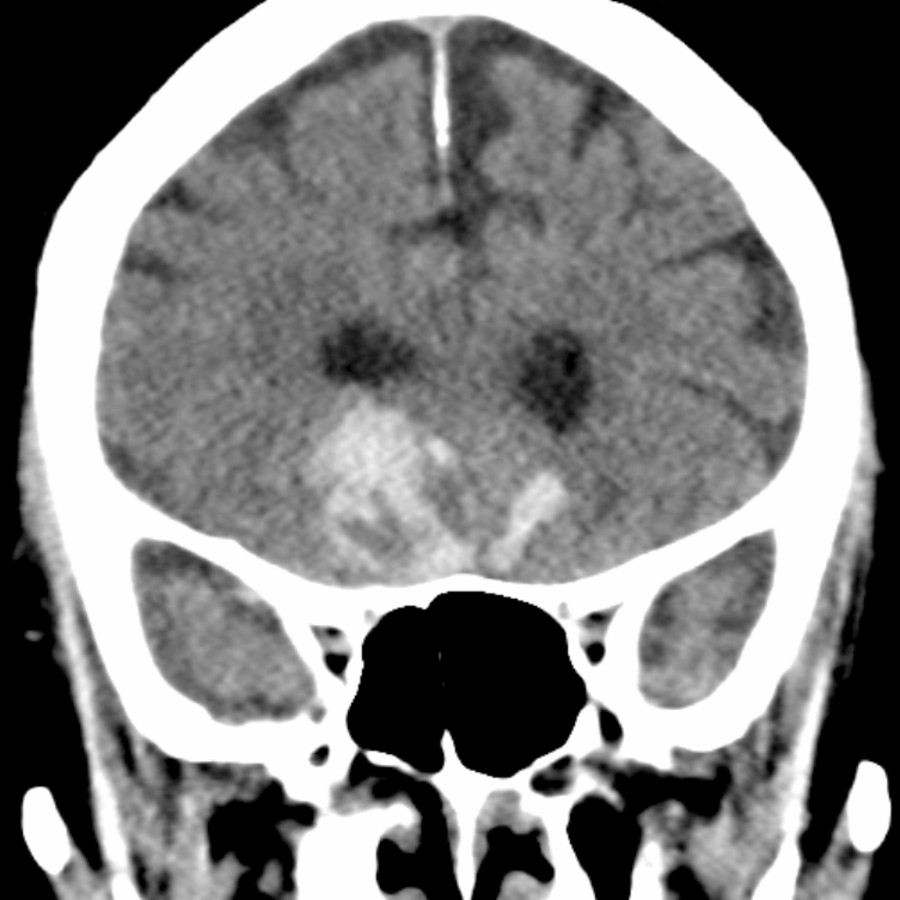Coronal NECT shows hyperdense acute hemorrhage in the inferior frontal lobes in a patient with a history of motor vehicle collision. The inferior frontal and anterior temporal lobes are the most common locations for traumatic contusions.