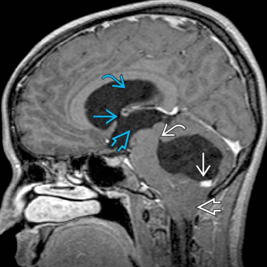 Sagittal T1 C+ MR shows a cystic mass with an enhancing nodule
, consistent with hemangioblastoma, pushing the tonsils inferiorly through the foramen magnum
. Note effaced 4th ventricle
, enlarged foramen of Monro
, and enlarged 3rd
and lateral
ventricles, consistent with obstructive hydrocephalus.