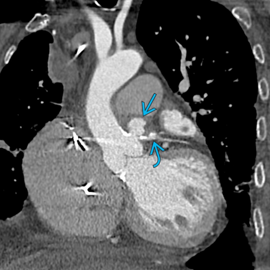 Coronal oblique CECT in the same patient shows the relationship of PAU
with the ascending aorta and left coronary artery
. Location in the ascending aorta and acute chest pain are the most important factors that determine emergent treatment due to high risk of rupture.