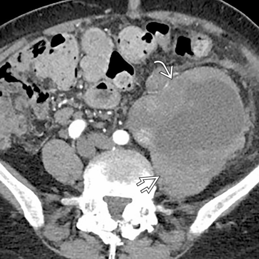 Axial CECT shows a large mixed cystic and solid mass
involving the left psoas muscle
, representing a primary retroperitoneal leiomyosarcoma.