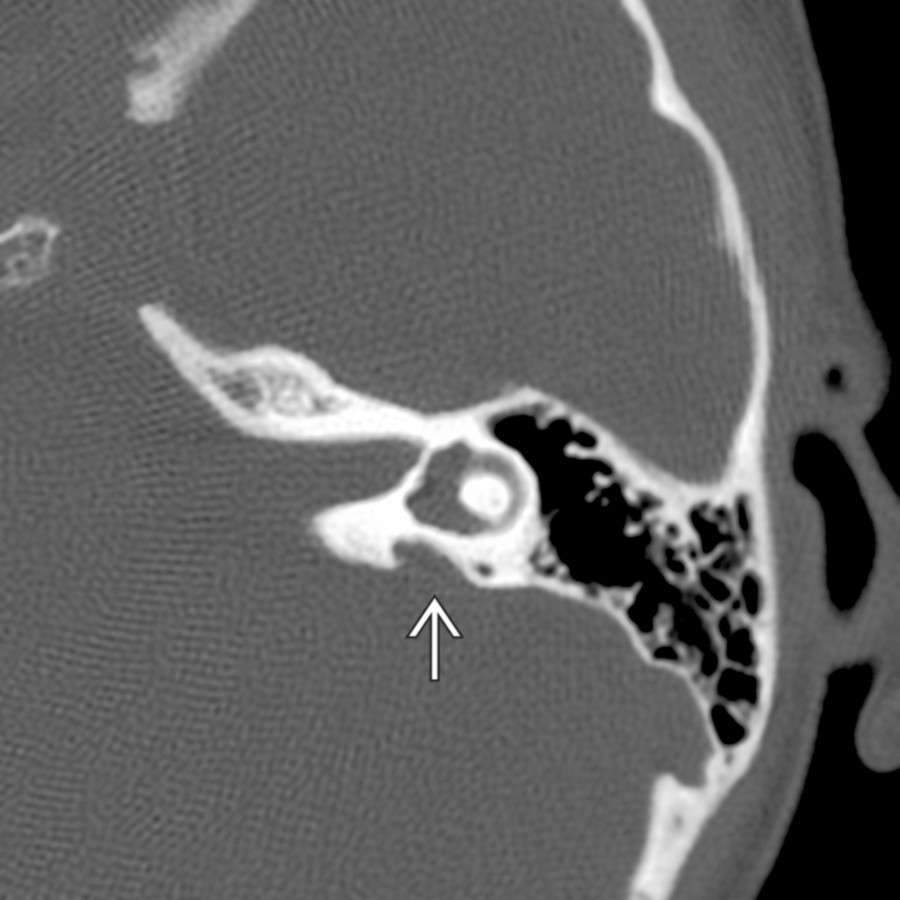 Axial bone CT demonstrates enlargement of the left bony vestibular aqueduct
.