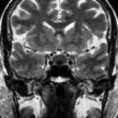 Coronal T2 MR in the same patient demonstrates that the cyst
is primarily hypointense. Note the intracystic nodule
. Rathke cleft cyst was found at surgery.