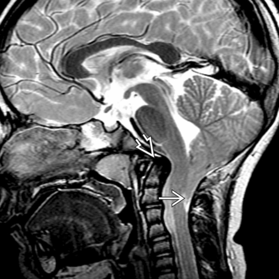 Sagittal T2 MR in a patient with occipital headaches shows a significantly pointed configuration of a low-lying cerebellar tonsil
to the level of the midposterior ring of C2. Notice also the dorsally tilted dens
and effacement of CSF at the foramen magnum.