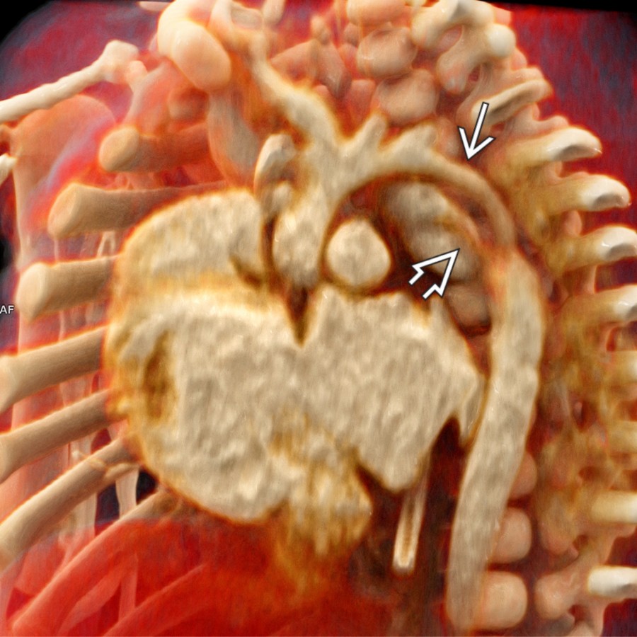Sagittal oblique CTA cinematic rendering in the same patient shows a hypoplastic aortic arch
and PDA
. CT is the best noninvasive imaging modality to assess aortic arch and supraaortic vessel patterns as well as to measure vessel diameters.