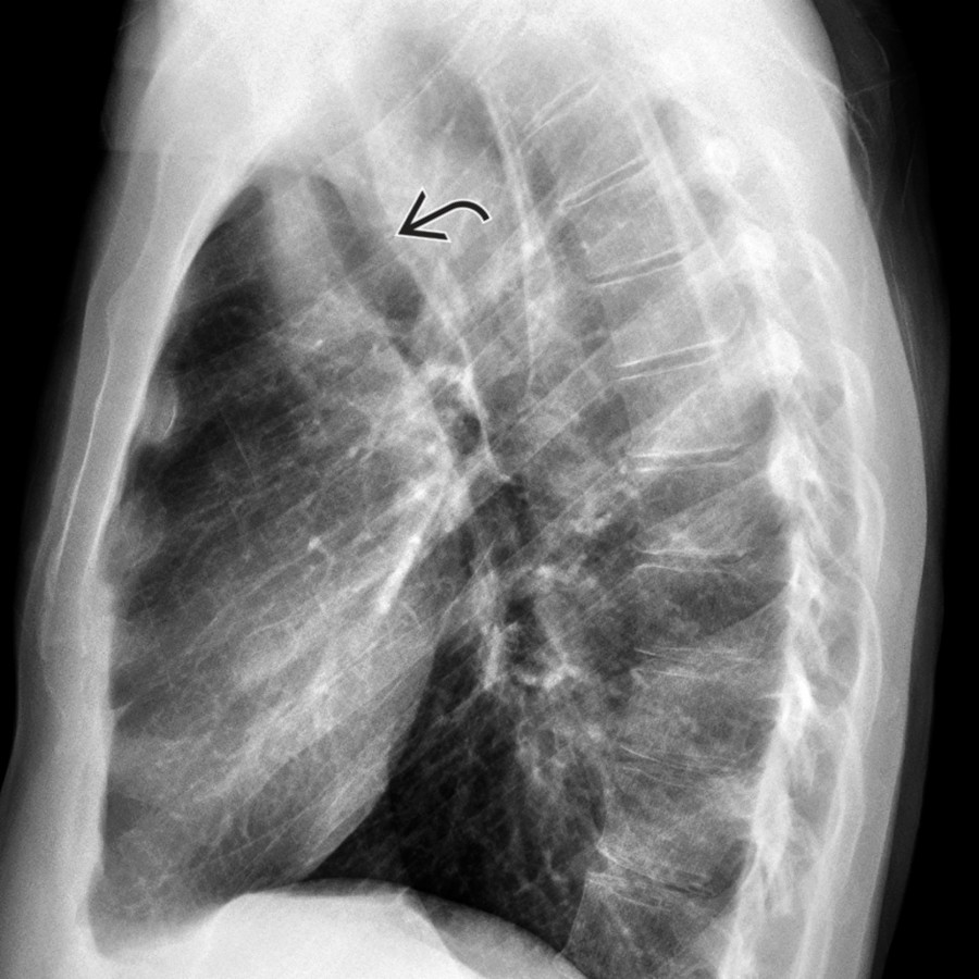 Lateral chest radiograph in the same patient shows an indentation of the posterior tracheal margin
, which relates to the presence of a KD. This suggests that mirror-image branching is not present. Note that KD implies the presence of a vascular ring, which may or may not be symptomatic.