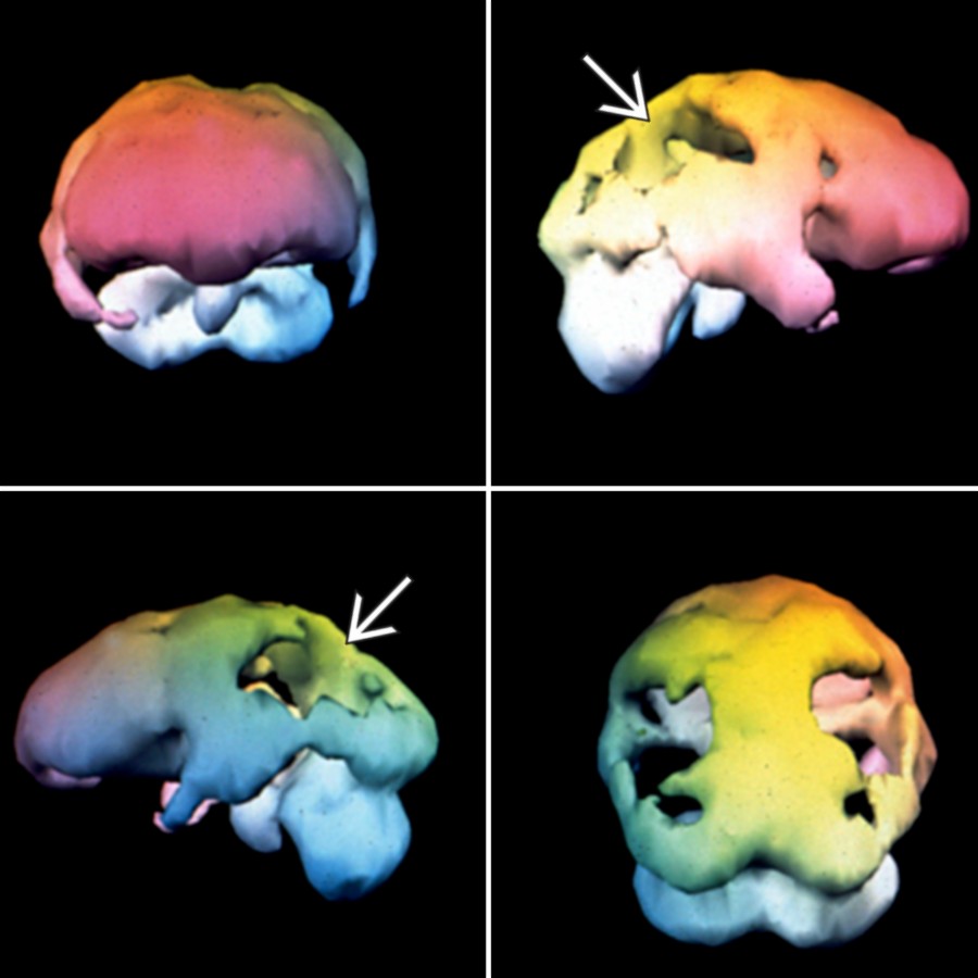 Alzheimer dementia is shown. Note the parietal and posterior temporal reductions
and sparing of occipital and frontal lobes.