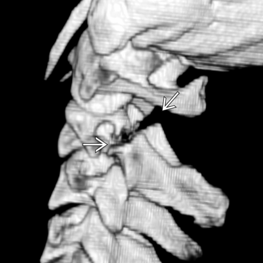 Sagittal oblique 3D CT shows bilateral C2 pedicle fractures
without fracture of the vertebral body. Effendi classification uses the presence of disruption of the C2-C3 disc and facet joints as a measure of the severity of injury.
