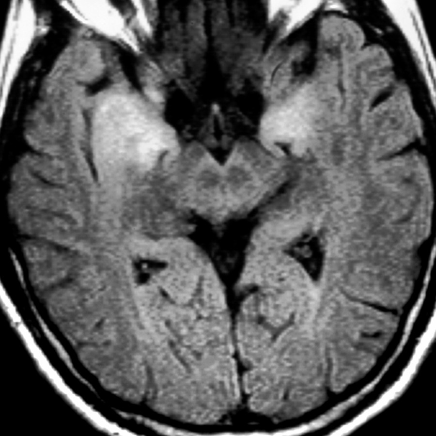 Axial FLAIR MR shows abnormal hyperintensity in the medial temporal lobes bilaterally, related to LE. As imaging mimics herpes encephalitis, most patients are initially treated with antiviral therapy until HSV titers are found to be negative. < 1% of cancer patients develop a paraneoplastic syndrome.