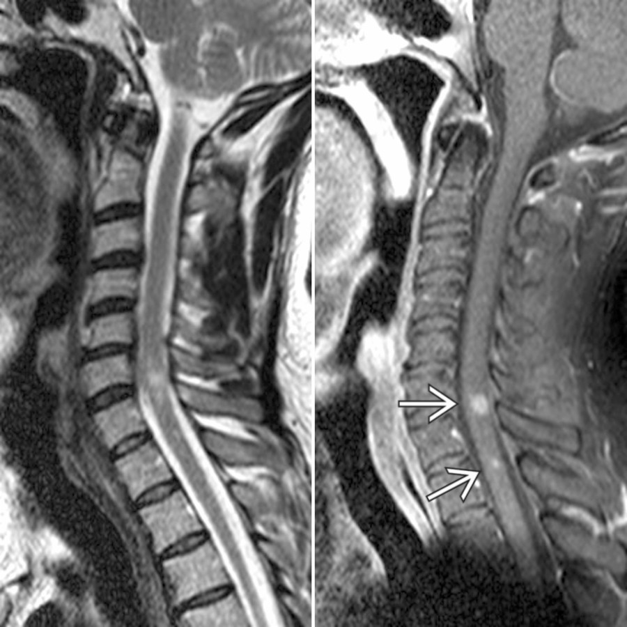 Sagittal T2 (left) & T1 C+ FS (right) MR show several T2-hyperintense foci in the cervical cord in this patient with MS. 2 of the lesions enhance reflecting active demyelination
.
