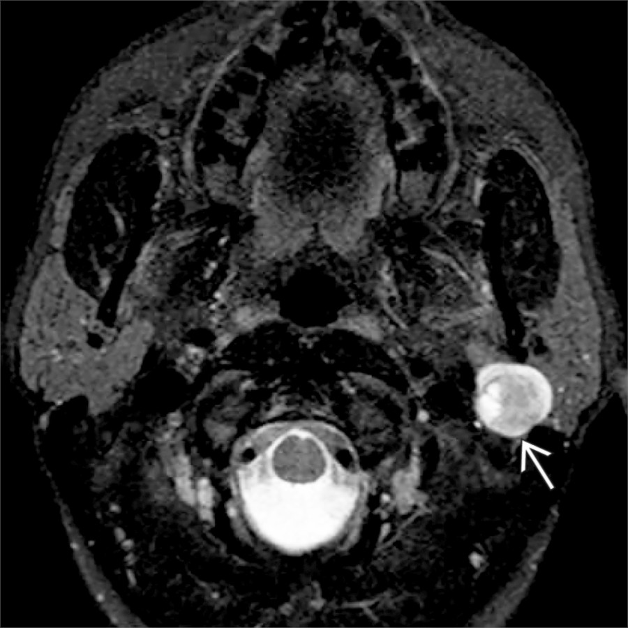 Axial T2 FS MR shows a heterogeneous, hyperintense parotid mass wedged into the stylomastoid foramen
. The location & characteristic target sign suggest the possibility of facial schwannoma.