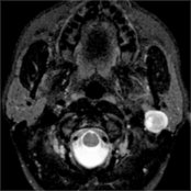 Axial T2 FS MR shows a heterogeneous, hyperintense parotid mass wedged into the stylomastoid foramen
. The location & characteristic target sign suggest the possibility of facial schwannoma.