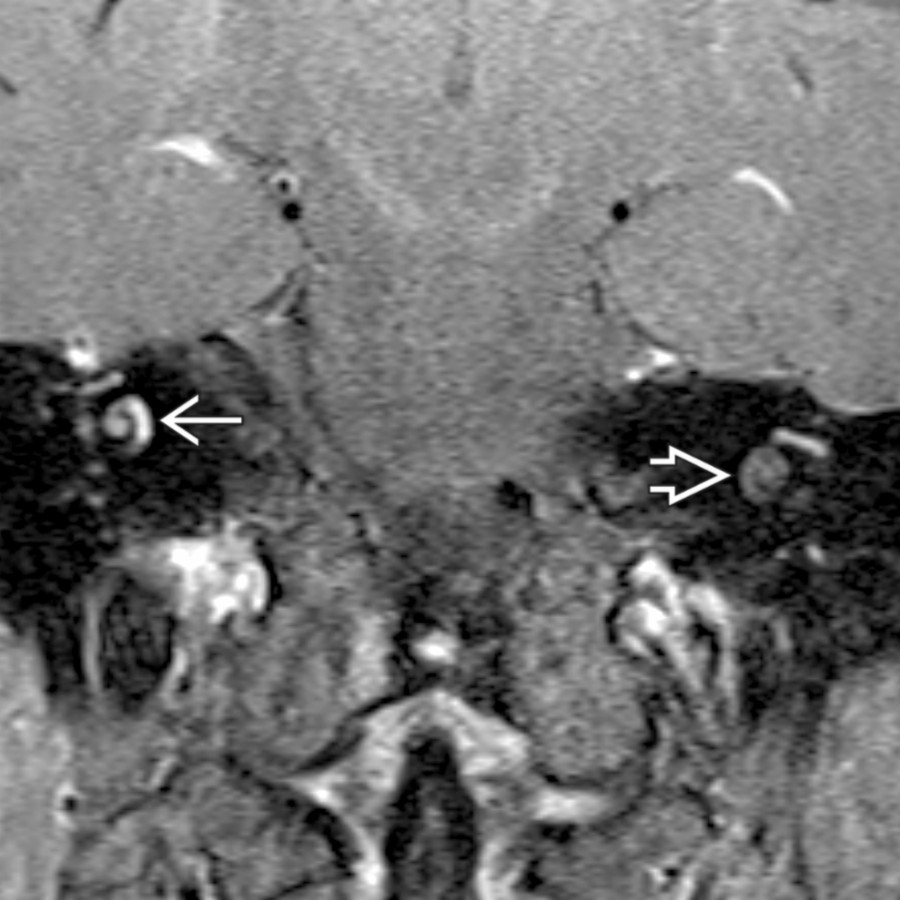 Coronal T1 C+ FS MR of an intracochlear schwannoma shows abnormal enhancement in the middle turn of the right cochlea
. Note the normal postcontrast appearance of the contralateral cochlea for comparison
.