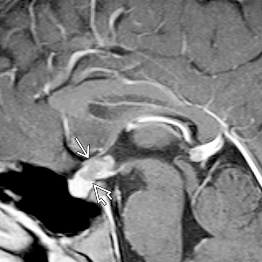 Sagittal T1 C+ MR shows a germinoma with sellar
and suprasellar
involvement. The infundibular stalk is markedly thickened, while the pineal gland is normal.