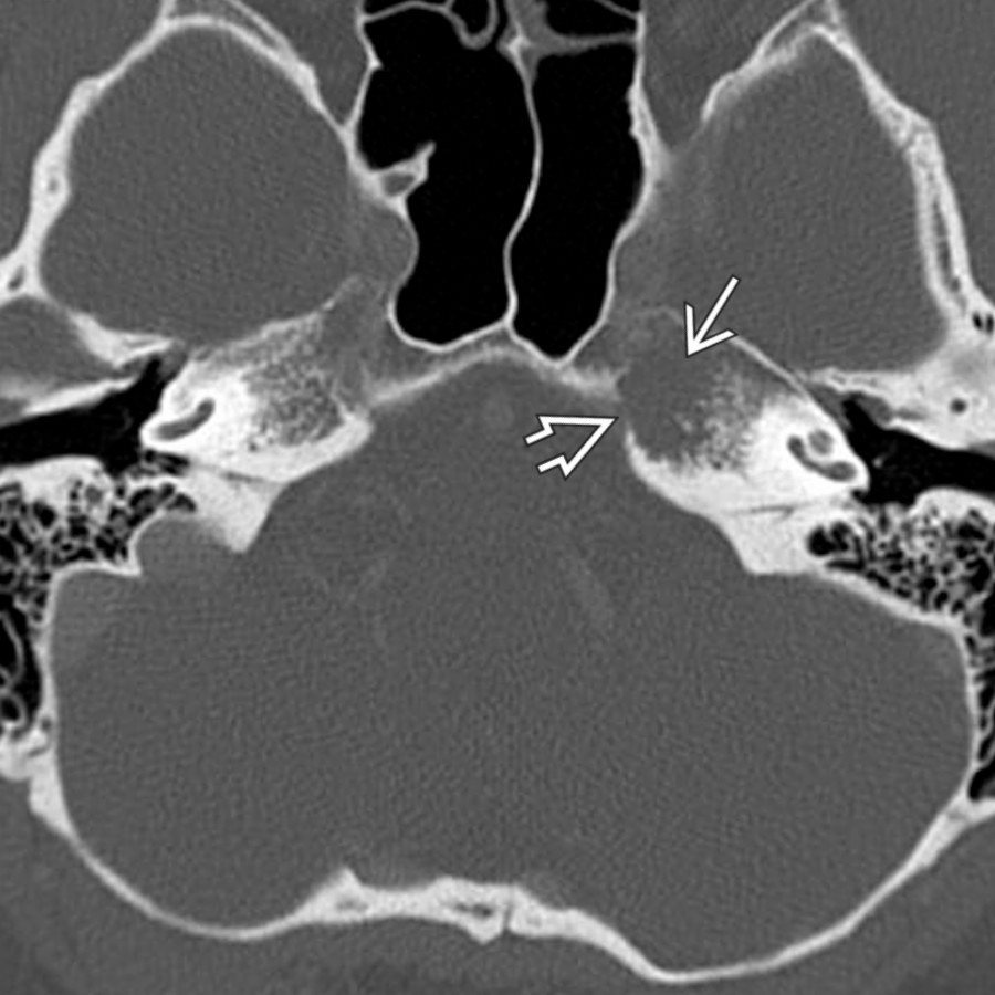 Axial bone window CT shows subtle bone destruction
with cortical erosion
in this small left petrous apex chondrosarcoma. No calcified matrix is seen. MR showed a corresponding T2-hyperintense and enhancing mass in this location.