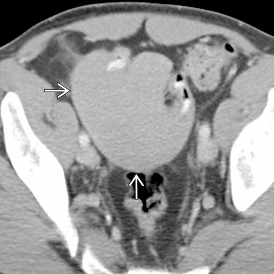 Axial CECT demonstrates a well- circumscribed, homogenous mass
in the pelvis involving the colon and small bowel, found to be a desmoid tumor at resection.