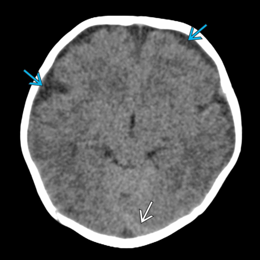 Initial axial NECT in the same patient shows SDH
layering along the left tentorium with a slight ↑ in bifrontal hypodense extraaxial spaces
.