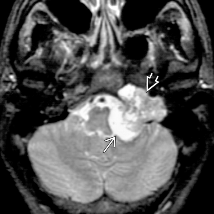 Axial T2 FS MR reveals a large, sharply marginated lesion expanding the left jugular foramen
. The high-signal mass projects medially into the low CPA cistern where it compresses the brainstem
.