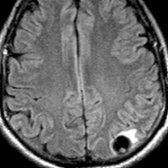 Axial FLAIR MR demonstrates a classic parenchymal neurocysticercal cyst
with an eccentric nodule (scolex)
in the left parietal lobe. Cyst fluid is isointense to CSF. Note mild perilesional edema
.