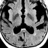 Axial FLAIR MR shows marked atrophy of the temporal lobes and enlargement of the sylvian fissures.
