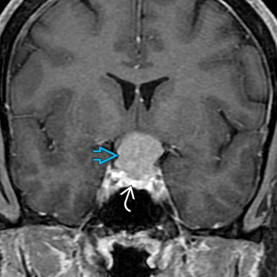 Coronal T1 C+ FS MR shows a suprasellar enhancing mass
separate from the normal pituitary gland below
. Meningiomas often have associated hyperostosis of the adjacent bone. Additionally, these benign tumors enhance homogeneously and may have an associated dural tail.