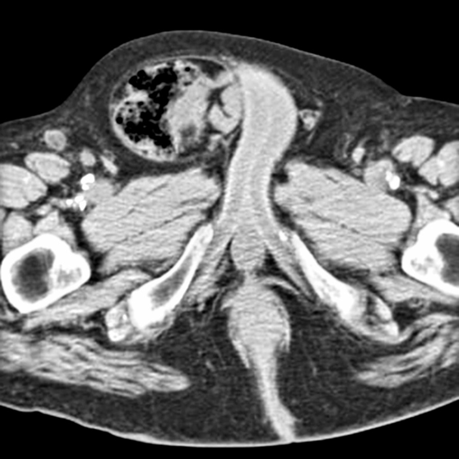Axial CECT shows a right inguinal hernia with the colon in the upper scrotum.