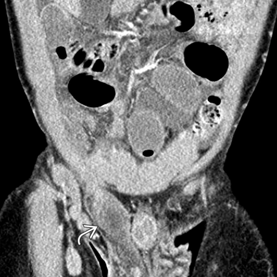 Coronal CECT in the same patient demonstrates that the small bowel extends into a right inguinal hernia
with a transition point in the hernia sac. This incarcerated hernia could not be manually reduced, and urgent surgery was performed for repair.