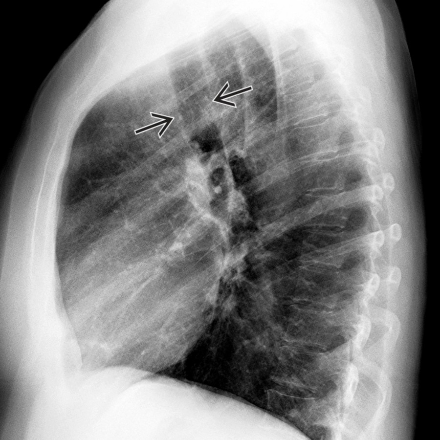 Lateral chest radiograph in the same patient shows the normal configuration of the trachea
. ALSA with KD can show indentation of posterior tracheal margin; however, differentiation from ALSA without KD is not always possible.