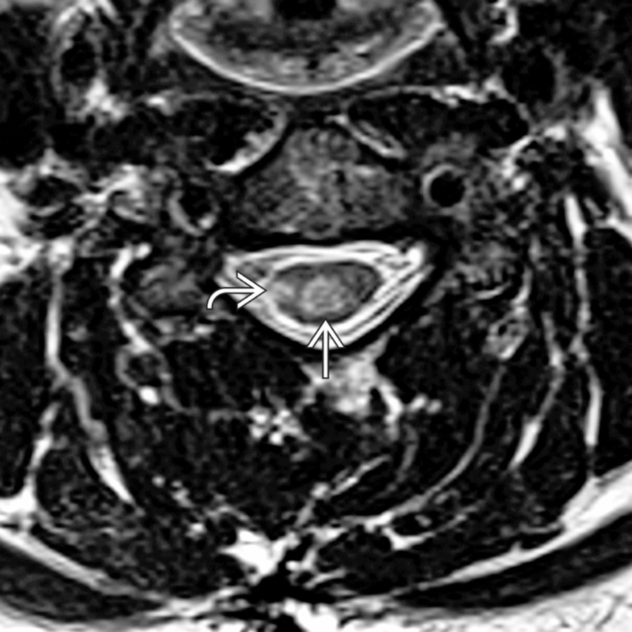 Axial T2WI MR shows focal T2-hyperintense demyelinating lesions with both central
& peripheral involvement
. T2-hyperintense lesions are not specific for plaque age, degree of myelin & axon loss, or amount of edema & inflammation.