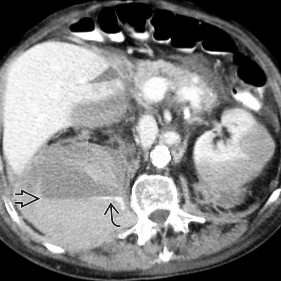 Axial CECT shows hemorrhage into multiple sites, including iliopsoas, with active bleeding
and hematocrit sign
, indicating coagulopathic bleeding.