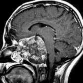 Sagittal T1WI C+ MR shows a large recurrent craniopharyngioma in the central skull base and nasopharynx
with typical heterogeneous cystic and solid morphology. (Courtesy S. Blaser, MD.)