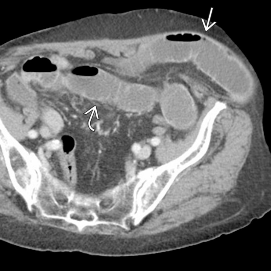 Axial CECT shows a small bowel obstruction and a Spigelian hernia
. A segment of small bowel herniates through the defect, resulting in obstruction and dilatation of the upstream bowel
.