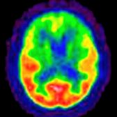FDG PET in a patient with FTD & dementia depicts glucose hypometabolism (green regions in the cortex) in the frontal lobes. (Courtesy N. Foster, MD & the University of Michigan PET Center.)