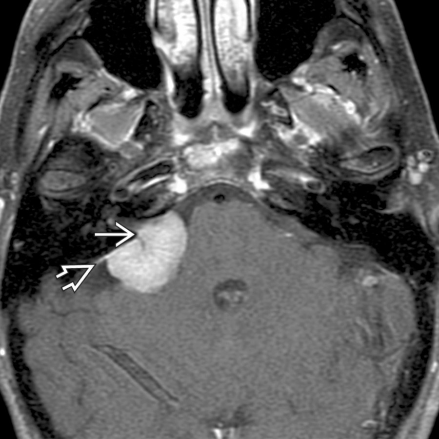 Axial T1 C+ FS MR shows the sessile morphology of meningioma as it "sits" on the posterior T-bone wall. Note the characteristic dural tail
and dural artery
feeding the tumor center.