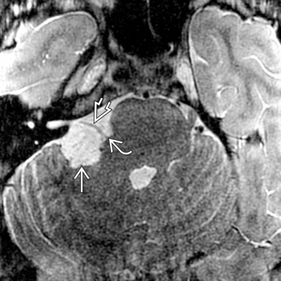 Axial T2 MR shows a right CPA cistern epidermoid cyst
scalloping the cerebellar contour and bowing the cisternal facial nerve anteriorly
. The root exit zone is also affected
.