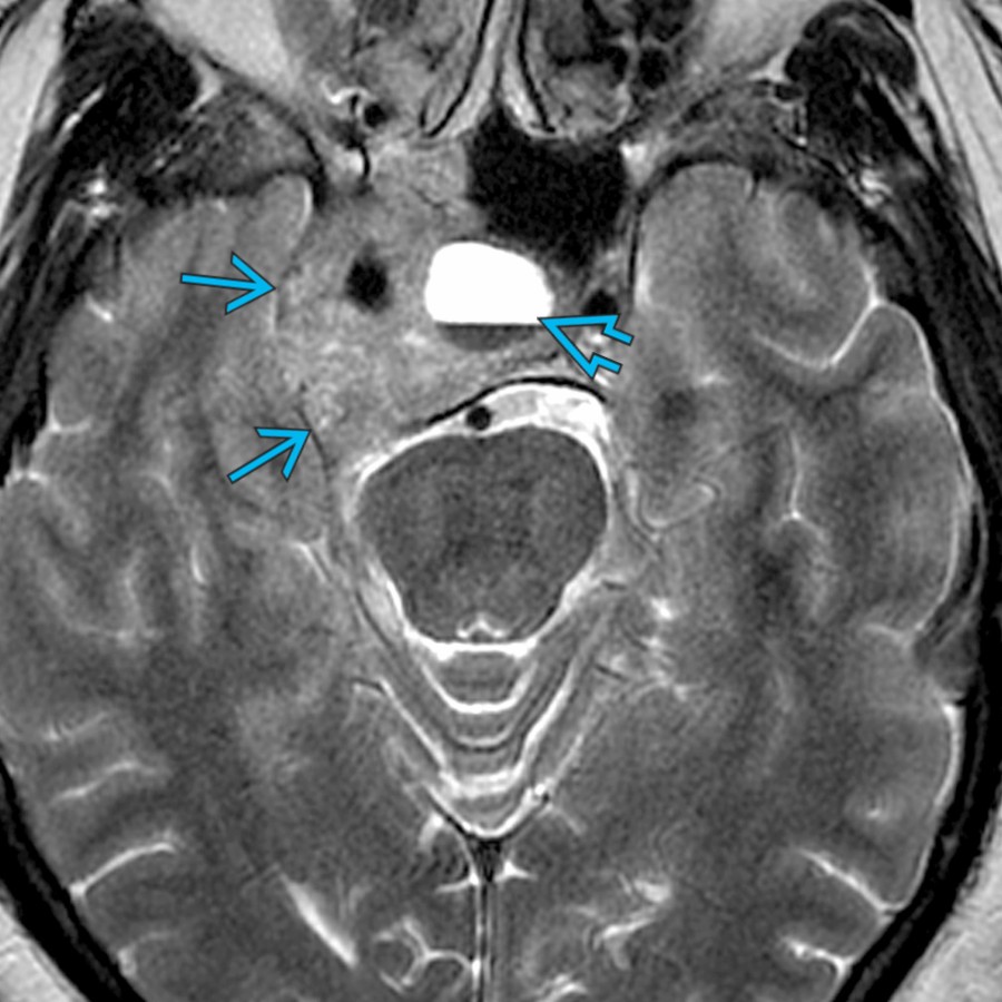 Axial T2 MR shows a large pituitary macroadenoma
with cavernous sinus invasion on the right. There is a blood fluid level
related to hemorrhage in this patient who presented with acute headache, visual changes, and ophthalmoplegia. Pituitary apoplexy may be caused by hemorrhage or infarction of the pituitary gland, often within an adenoma.