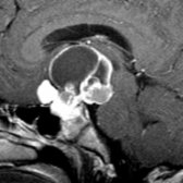 Sagittal T1WI C+ MR shows a complex cystic suprasellar mass with an enhancing rim
and solid components
. The cysts contain fluid of different signal intensities. Note the large suprasellar, smaller intrasellar
components in this classic craniopharyngioma.