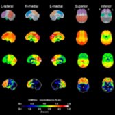 Sagittal SSP FDG PET scan in a 72-year-old man with FTD shows a normal elderly control map (2nd row), the patient's glucose metabolism (3rd row), & Z-score statistical map (bottom row). The frontal lobes
are strikingly hypometabolic. The temporal lobes
are somewhat less severely affected.