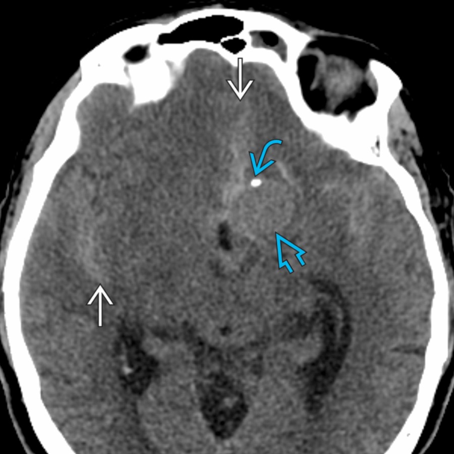 Axial NECT shows scattered subarachnoid hemorrhage
within the interhemispheric and sylvian fissures. A rounded hypodense lesion
with peripheral calcification
in the left suprasellar cistern is the causative ruptured saccular ICA aneurysm.