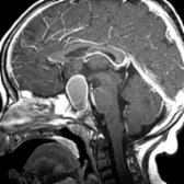 Sagittal T1 C+ MR shows a principally cystic, sellar/suprasellar mass with rim enhancement
.