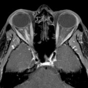 Axial T1 C+ MR in a 22-year-old woman with right vision loss demonstrates swelling with enhancement
of the intraorbital segment of the right optic nerve.
