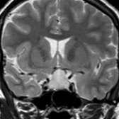Coronal T2 MR in a pregnant woman with visual changes and endocrine abnormalities shows a hyperintense sellar/suprasellar mass related to LH with superior displacement of the optic chiasm
. Imaging mimics pituitary macroadenoma.