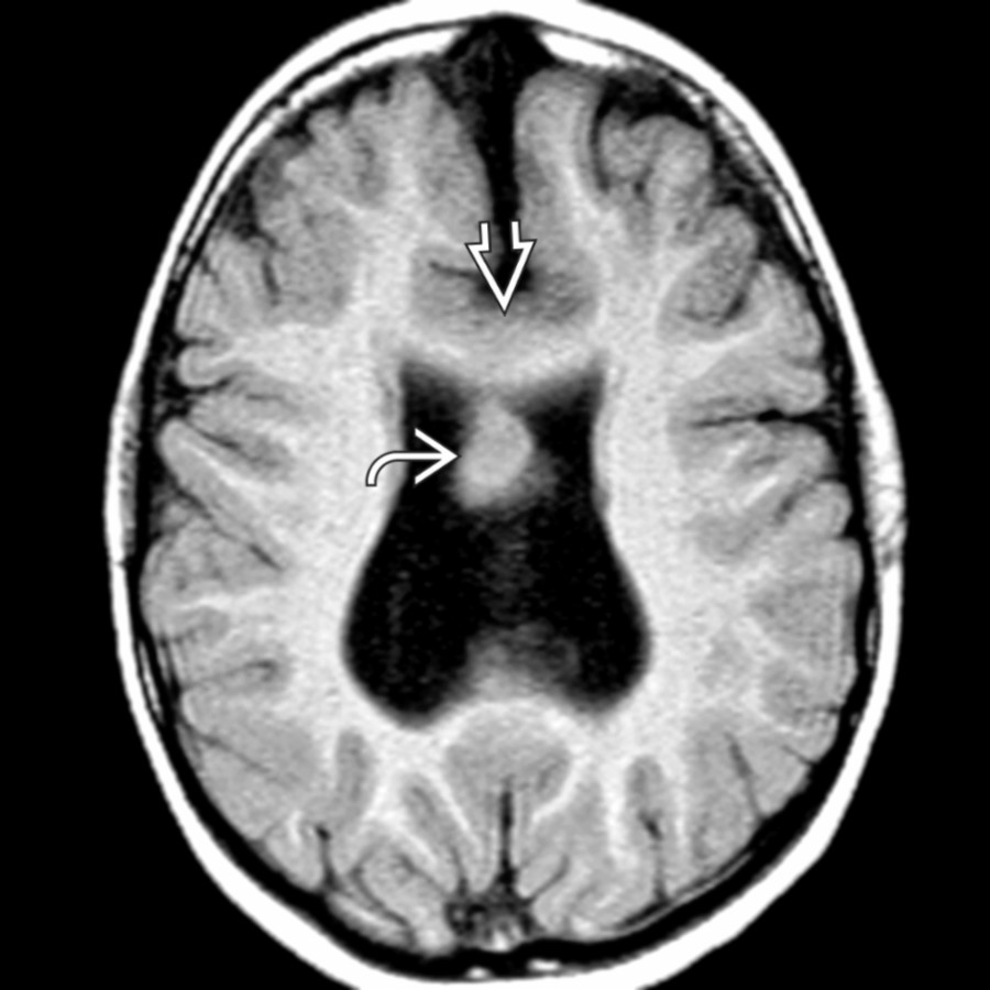 Axial T1 MR in the same patient shows gray & white matter traversing the midline
in the expected location of the splenium. Gray matter also protrudes
into the ventricular system. The septum pellucidum is absent.