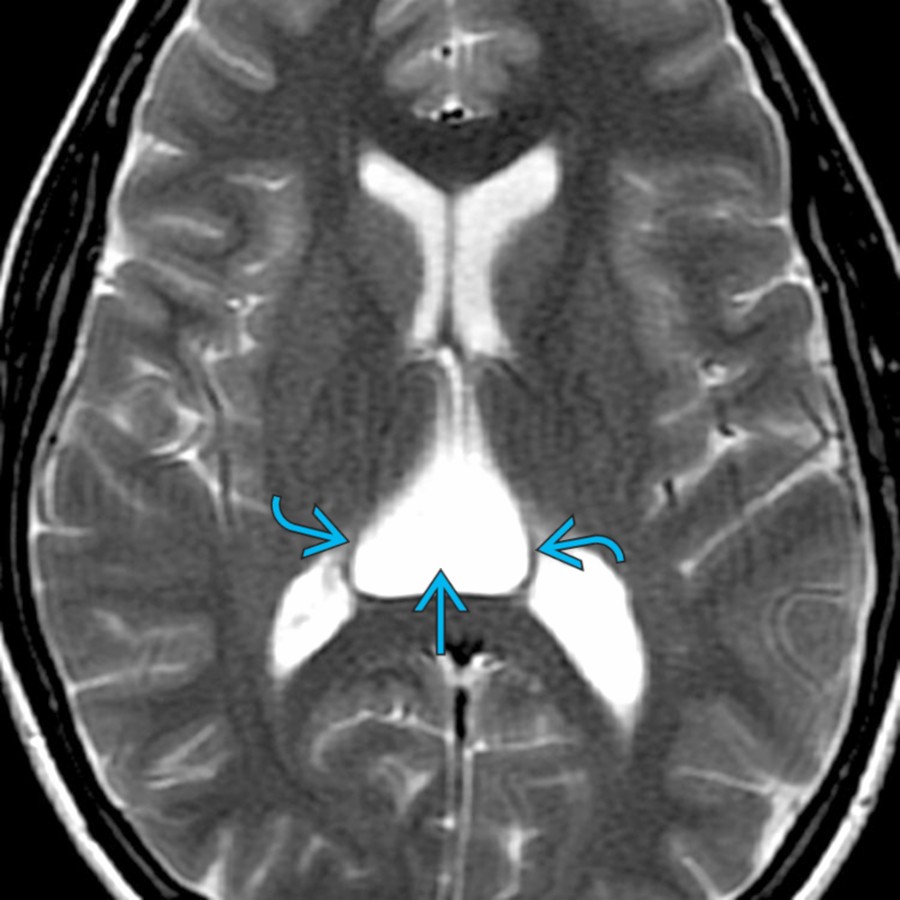 Axial T2 MR in a 37-year-old man with headaches shows a triangular-shaped CSF collection
between the lateral ventricles, spreading the fornices laterally
.
