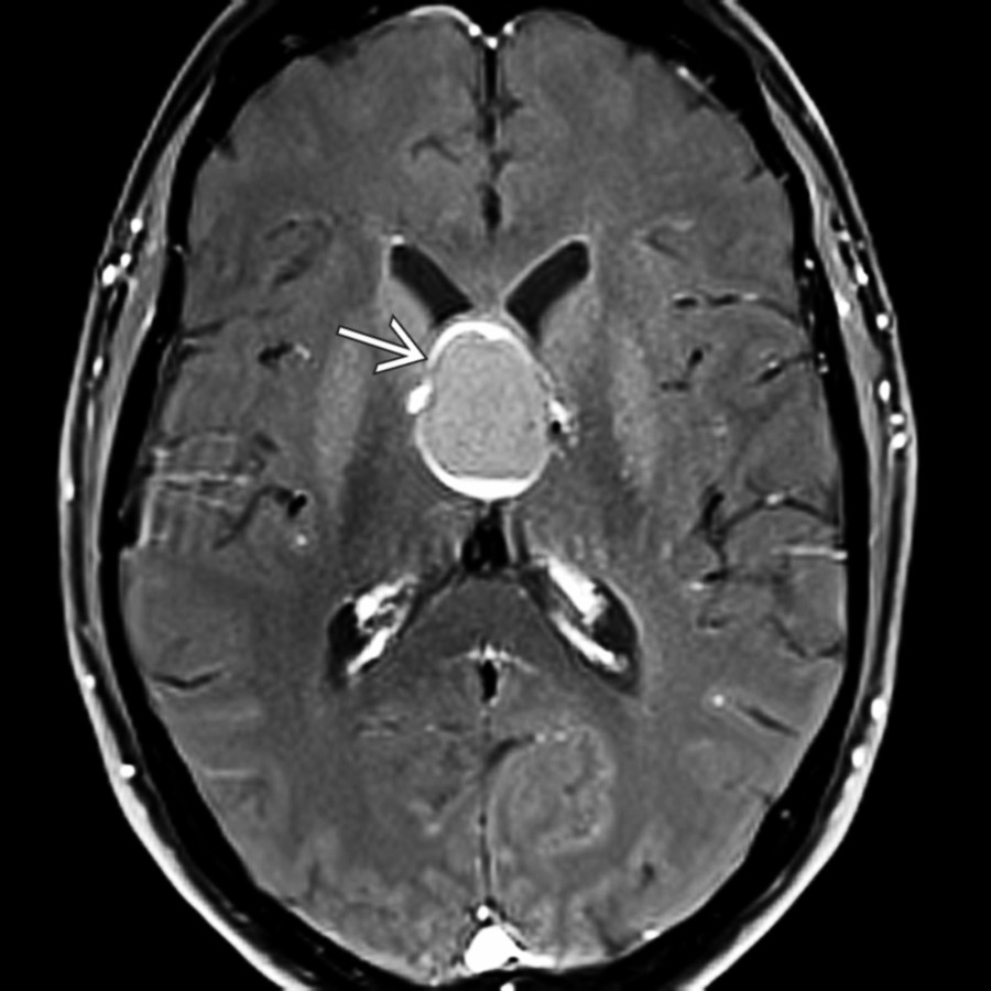 Axial T1 C+FS MR shows rim enhancement
around the cyst wall.
